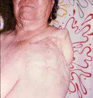 Mujer amputada del brazo izquierdo con resección de la glandula mamaria, musculos pectorales, contenido axilar y escápula