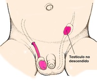 Criptorquidia, es la falta de descenso de testiculo en el infante, puede alojarse en el abdomen, en la pelvis o en el canal inguinal, lo que predispone a cáncer testicular