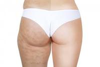 Cellulite verwijderen met Pascaud Wave