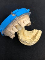 zirconio monolitico e moncone personalizzato dall'operatore programma EXOCAD