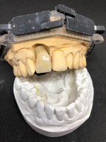 zirconio monolitico e moncone personalizzato dall'operatore programma EXOCAD