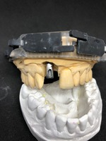 zirconio monolitico e moncone personalizzato dall'operatore programma EXOCAD