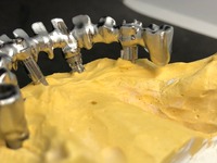 PROTESI FISSA: metallo fresato, per arcata su impianti avvitata
