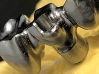 PROTESI FISSA: metallo fresato, per arcata su impianti avvitata