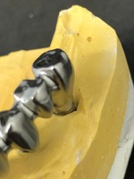 PROTESI FISSA: metallo fresato, per arcata su impianti avvitata