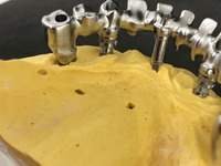 PROTESI FISSA: metallo fresato, per arcata su impianti avvitata