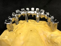 PROTESI FISSA: metallo fresato, per arcata su impianti avvitata