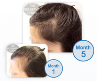 Forrás: https://www.belgraviacentre.com/blog/could-your-hair-loss-be-caused-by-a-thyroid-disorder-2/