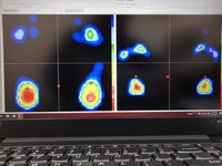 素足とオルソティックで立った比較