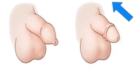 Přetahování předkožky