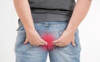 Hemeroid. Foto: Shutterstock.com