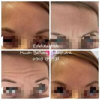 Botox -čelo, vráska hnevu