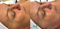 IMAGE Signature Facelift gyorsfeltöltő kezelés mindössze 35 perc alatt!