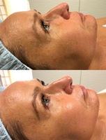 IMAGE Facelift II.