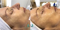 Image Facelift I.