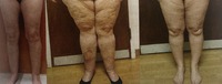 Stages of lipedema 1-3 &2