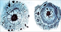 Neuritic plaques are one of the characteristic structural abnormalities found in the brains of Alzheimer patients