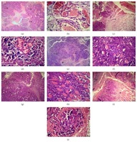 Spirulina platensis Lacks Antitumor Effect against Solid Ehrlich Carcinoma in Female Mice. Histopathological examination of Ehrlich ascites carcinoma (EAC) solid tumor. Representative sections were obtained from (a) untreated EAC-bearing mice (arrows: infiltration of subcutaneous tissue with tumor cells), (b) untreated EAC-bearing mice (arrows: newly formed blood capillaries; arrowheads: leukocyte infiltration), (c) EAC tumor-bearing mice treated with 5-fluorouracil 20 mg/kg (arrowheads: extensive necrosis; arrow: fibrosis; M: skeletal muscles), (d) EAC tumor-bearing mice treated with 5-fluorouracil 20 mg/kg (irregular arrow: destructed blood vessels and hemorrhage), (e) EAC tumor-bearing mice treated with spirulina 200 mg/kg (arrows: extensive infiltration of the subcutaneous tissue with tumor cells), (f) EAC tumor-bearing mice treated with spirulina 200 mg/kg (arrows: tumor cells with cellular anaplasia and anisocytosis), (g) EAC tumor-bearing mice treated with spirulina 800 mg/kg (arrows: moderate infiltration of the tumor cells; arrowhead: numerous leukocyte infiltration), (h) EAC tumor-bearing mice treated with spirulina 800 mg/kg (arrows: huge numbers of tumor cells infiltrating the skeletal muscles), (i) EAC tumor-bearing mice treated with 5-fluorouracil 20 mg/kg plus spirulina 200 mg/kg (arrows: less infiltration with tumor cells; N: extensive necrosis and fibrosis), and (j) EAC tumor-bearing mice treated with 5-fluorouracil 20 mg/kg plus spirulina 200 mg/kg (arrows: islets of viable tumor cells; N: extensive necrosis). Sections were stained with HE dyes (scale bar = 50 μM). Waleed Barakat, et al. Adv Pharmacol Sci. 2015;2015:132873.