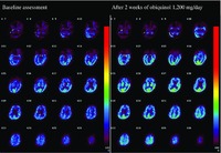 Three-Year Follow-Up of High-Dose Ubiquinol Supplementation in a Case of Familial Multiple System Atrophy with Compound Heterozygous COQ2 Mutations. CMRO2 images before and after ubiquinol supplementation at 1200 mg/day Jun Mitsui, et al. Cerebellum. 2017;16(3):664-672.