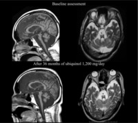 Three-Year Follow-Up of High-Dose Ubiquinol Supplementation in a Case of Familial Multiple System Atrophy with Compound Heterozygous COQ2 Mutations. Brain MR images of patient. Upper images were obtained at 60 years of age (before supplementation of ubiquinol), and lower images were obtained at 63 years of age (after 36 months of ubiquinol 1200 mg/day). T1-weighted sagittal images (left) and T2-weightd axial images at the middle regions of the pontine base (right). They show gross atrophy of the infratentorial structures especially in the pons, middle cerebellar peduncle, and cerebellum Jun Mitsui, et al. Cerebellum. 2017;16(3):664-672.