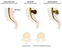 Ilustração de alterações do canal vertebral