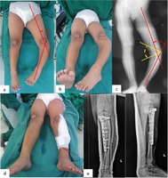 Cirurgia para tratamento de doença de Blount