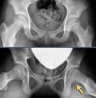 RX de paciente com Epifisiólise proximal do fêmur