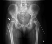 Diagnostico ( linha de Trethovan ) Epifisiólise proximal do fêmur