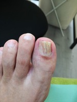 Onicomicosis