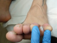 Dermatomicosis