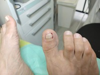 Uñas encarnadas