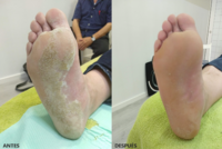 Hiperqueratosis | hiperhidrotica