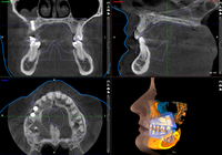 3 x 3D = CBCT + ProFace + escaneo de impresión