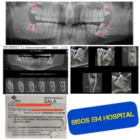 Extração de Sisos em Hospital???? Casos que apresentem imperativo clínico que motivem a realização destes, de forma exclusiva, em ambiente hospitalar, conforme previsto na resolução normativa 428/ Agência Nacional de Saúde – ANS. Quando a extração do siso deve ser realizada em ambiente hospitalar São considerados imperativos clínicos: * Pacientes idosos, * Crianças e/ou adultos com necessidades especiais, * Pessoas com doenças prévias, transtornos de ansiedade ou qualquer situação clínica que necessite de suporte anestésico ou de sedação para realização do procedimento. Vale salientar que as intervenções bucomaxilofacias que necessitam de internação hospitalar não são cobertas pelo plano odontológico. Mesmo realizadas por profissionais da odontologia, estas cirurgias têm sua cobertura assegurada pelo plano de saúde de assistência médica, na segmentação hospitalar. O cirurgião bucomaxilofacial avalia e justifica a necessidade de suporte hospitalar para a realização do procedimento odontológico, sempre com o objetivo de garantir maior segurança ao paciente, assegurando as condições adequadas para a execução dos procedimentos. Fatores envolvidos na realização da extração em hospital: – Localização e grau de dificuldade do procedimento – Anatomia do sítio cirúrgico – Risco de fratura óssea – Idade do paciente – Adequada analgesia e segurança do procedimento – Comorbidades (doenças) prévias – Doenças psiquiátricas Cada caso ser minuciosamente considerado pelo especialista (Cirurgião Bucomaxilofacial), que recomendará o que for mais adequado e seguro a cada paciente. Consulte se seu profissional está inscrito como especialista no conselho regional de odontologia (https://cro-df.implanta.net.br/servicosonline/Publico/ConsultaInscritos/) ☎️61 3541 7641 ☎️61 98122 5299