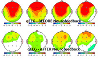 QEEG antes y después del Neurofeedback. El color verde nos indica que está dentro de valores normales.