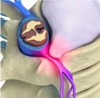 Medzistavcová platnička ako zdroj bolesti v oblasti chrbta a krku, zlé držanie tela, preťažovanie