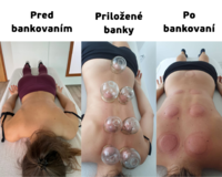 Pred a po bankovaní tela, modriny po vákuovom bankovaní chrbta, účinky bankovania na telo a organizmus