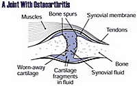 osteoarthritic joint