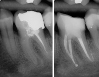 před a po endodontickém ošetření