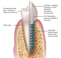 zub vs. implantát