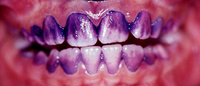 Placa dental visível após aplicação de corante