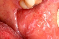 Lesione lichenoide precancerosa