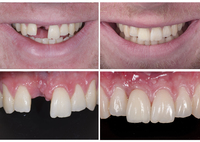 Corona in ceramica fissa su impianto dentale