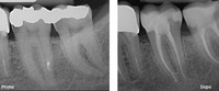 Radiografia trattamento endodontico