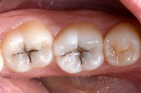 Denti cariati in superficie occlusale