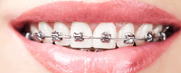 Trattamento ortodontico fisso con brackets metallici