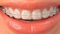 Trattamento ortodontico fisso con brackets ceramici