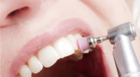 Lucidatura dentale del settore anteriore
