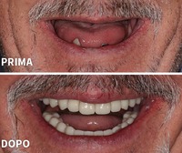 Riabilitazione totale implanto-protesica