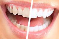 Trattamento di sbiancamento dentale professionale **